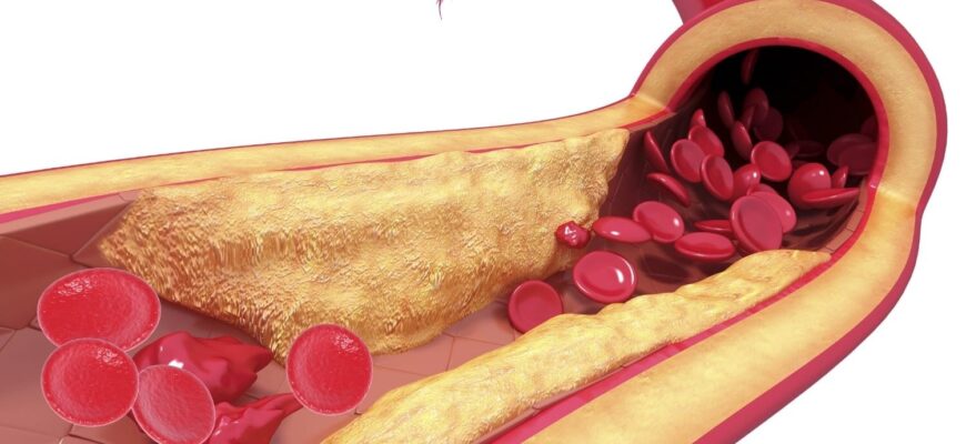 Холестериновые бляшки в сосудах шеи: лечение народными средствами