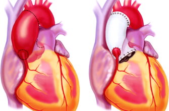 Узнаем, что такое атеросклероз аорты сердца