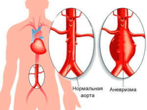 пластика аневризмы брюшной аорты