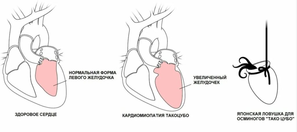 Синдром разбитого сердца